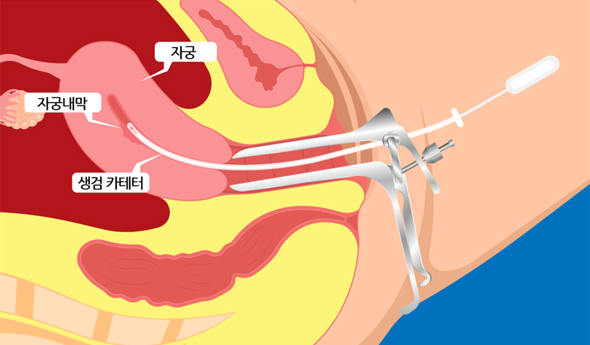 자궁내막 검체 채취