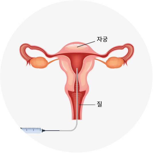 난관개통술 / 난관조영술