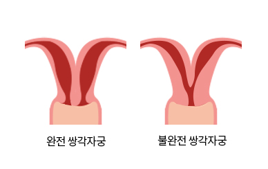 쌍각자궁